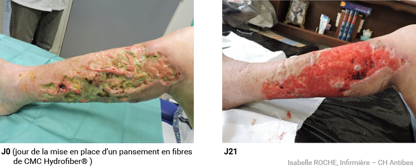 Plaie traumatique dans un contexte d’insuffisance veineuse chronique : détersion prise en charge avec AQUACEL® Extra™-⁷.J0 (jour de la mise en place d’ AQUACEL® Extra™) et J21 (Visuel Isabelle ROCHE, Infirmière – CH Antibes) Plaie traumatique dans un contexte d’insuffisance veineuse chronique : détersion prise en charge avec AQUACEL® Extra™-7 J0 (jour de la mise en place d’ AQUACEL® Extra™)-10 et J21 (Visuel Isabelle ROCHE, Infirmière – CH Antibes)
