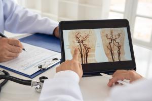 L'inversion des altérations des lipoprotéines chez les patients victimes d'un AVC ischémique ouvre peut-être de nouvelles perspectives thérapeutiques dans la gestion des maladies cardiovasculaires (Visuel Adobe Stock 1106737954)