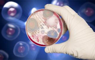 La diverticulite, une inflammation des diverticules, de petites poches présentes dans la muqueuse du gros intestin (côlon) peut être gérée globalement plus simplement (Visuel Adobe Stock 119677224) La diverticulite, une inflammation des diverticules, de petites poches présentes dans la muqueuse du gros intestin (côlon) peut être gérée globalement plus simplement (Visuel Adobe Stock 119677224)