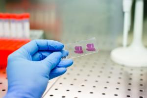 La fibrose hépatique est en cause dans de nombreuses maladies du foie, de l'hépatite à la stéatohépatite ou maladie du foie gras non alcoolique (Visuel Adobe Stock 197669254) La fibrose hépatique est en cause dans de nombreuses maladies du foie, de l'hépatite à la stéatohépatite ou maladie du foie gras non alcoolique (Visuel Adobe Stock 197669254)