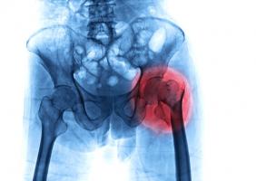 Les fractures de la hanche peuvent déclencher d’autres dommages collatéraux (Visuel Adobe Stock 287402884)