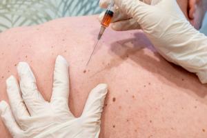 Le sexe a son importance dans la manière, le moment et l'endroit où se développent les mélanomes ? (Visuel Adobe Stock 357671552) Le sexe a son importance dans la manière, le moment et l'endroit où se développent les mélanomes ? (Visuel Adobe Stock 357671552)