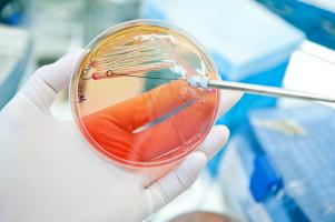 Une nouvelle cible possible pour un vaccin contre le cancer du côlon ? (Visuel Adobe Stock 55246874) Une nouvelle cible possible pour un vaccin contre le cancer du côlon ? (Visuel Adobe Stock 55246874)