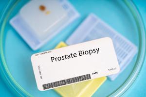 Une nouvelle technique de collecte d'échantillons de biopsie de la prostate, qui permet de réduire le risque d'infection par rapport aux approches traditionnelles (Visuel Adobe Stock 595758560) Une nouvelle technique de collecte d'échantillons de biopsie de la prostate, qui permet de réduire le risque d'infection par rapport aux approches traditionnelles (Visuel Adobe Stock 595758560)