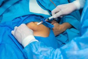 Plébiscitée, au fil des études et des essais, dans des indications de plus en plus larges, la chirurgie bariatrique démontre sa supériorité sur le mode de vie pour la rémission du diabète de type 2 (Visuel Fotolia 178236449) Plébiscitée, au fil des études et des essais, dans des indications de plus en plus larges, la chirurgie bariatrique démontre sa supériorité sur le mode de vie pour la rémission du diabète de type 2 (Visuel Fotolia 178236449)