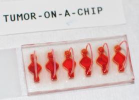 Il s'agit d'un système organoïde modèle de la tumeur du patient, qui va permettre d’étudier les effets bactériens sur l'immunothérapie (Visuel Wake Forest Baptist) Il s'agit d'un système organoïde modèle de la tumeur du patient, qui va permettre d’étudier les effets bactériens sur l'immunothérapie (Visuel Wake Forest Baptist).