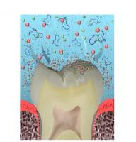 Un nouveau composite, ou un nouveau dentifrice préventif illustreront bientôt cette alternative aux soins actuels : la reminéralisation guidée par les peptides. Un nouveau composite, ou un nouveau dentifrice préventif illustreront bientôt cette alternative aux soins actuels : la reminéralisation guidée par les peptides.