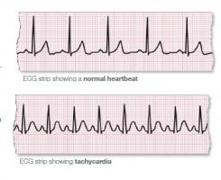 La fibrillation auriculaire (FA) est une affection cardiaque qui provoque un rythme cardiaque irrégulier et souvent anormalement rapide. La fibrillation auriculaire (FA) est une affection cardiaque qui provoque un rythme cardiaque irrégulier et souvent anormalement rapide.