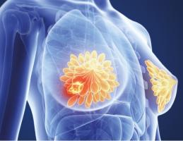 a consommation élevée de fruits et légumes, soit plus de 5 portions par jour, pourrait réduire le risque de cancer du sein de 11% a consommation élevée de fruits et légumes, soit plus de 5 portions par jour, pourrait réduire le risque de cancer du sein de 11%