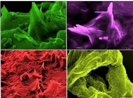 Les cristaux de cholestérol sont la signature incontestable d’un risque élevé de crise cardiaque