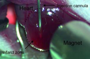 ? Cette méthode innovante consiste à charger les cellules musculaires injectées de nanoparticules magnétiques, à les maintenir en place par un aimant, ce qui permet une meilleure prise de greffe sur le tissu existant. 