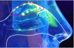 La perte de l'odorat a déjà été documentée comme un symptôme précurseur de la maladie d'Alzheimer