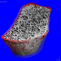 Près de 9 millions de cas de fractures liées à l'ostéoporose sont recensés chaque année