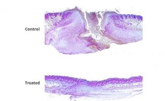 En incorporant un médicament inhibiteur de gènes dans un gel en vente libre, ces chercheurs parviennent à réduire de moitié le temps de cicatrisation En incorporant un médicament inhibiteur de gènes dans un gel en vente libre, ces chercheurs parviennent à réduire de moitié le temps de cicatrisation