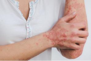 De nombreuses études ont montré que les patients atteints de psoriasis encourent un risque accru de maladies cardiovasculaires (Visuel Estzer Miller pour le Chinese Medical Journal) De nombreuses études ont montré que les patients atteints de psoriasis encourent un risque accru de maladies cardiovasculaires (Visuel Estzer Miller pour le Chinese Medical Journal)