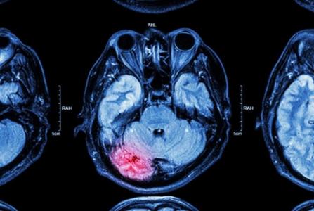 L'intervention consiste à supprimer les nouveaux neurones formés à la suite d'une crise. 