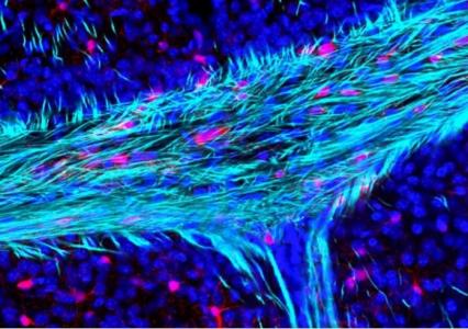 La perte de la myéline en cause dans les maladies démyélinisantes apparaît également  comme un facteur majeur de détérioration du cerveau liée à l'âge (Visuel Dr Andrea Rivera). 