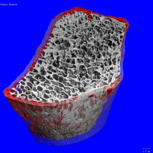 Près de 9 millions de cas de fractures liées à l'ostéoporose sont recensés chaque année