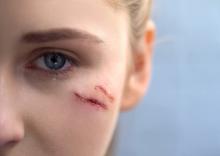 Pourquoi une plaie au visage laisse en général moins "de cicatrice" (ou fibrose) que sur le reste du corps (Visuel Adobe Stock 239796552) Pourquoi une plaie au visage laisse en général moins "de cicatrice" (ou fibrose) que sur le reste du corps (Visuel Adobe Stock 239796552)